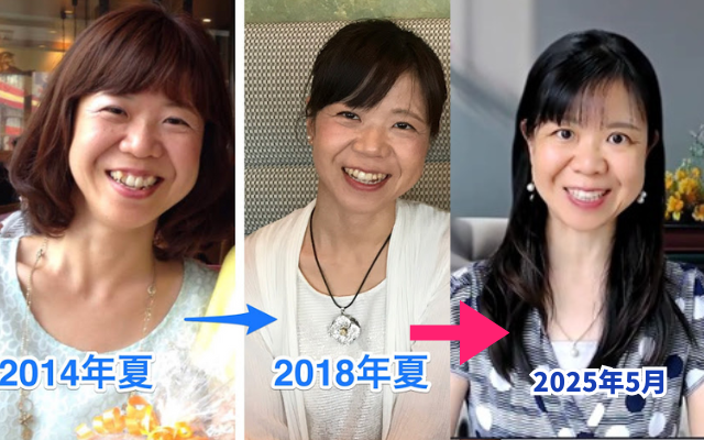 過食嘔吐で歯がボロボロの状態から完治後に歯科矯正